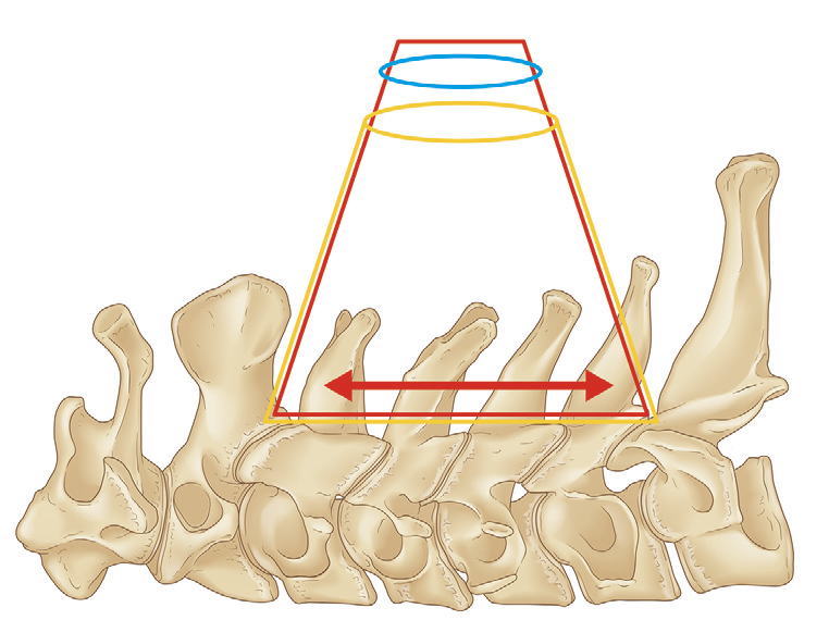 小切開から椎弓全体へ広がる作業域の幾何学図 — 皮膚切開 3cm から椎弓全体に届く台形作業域