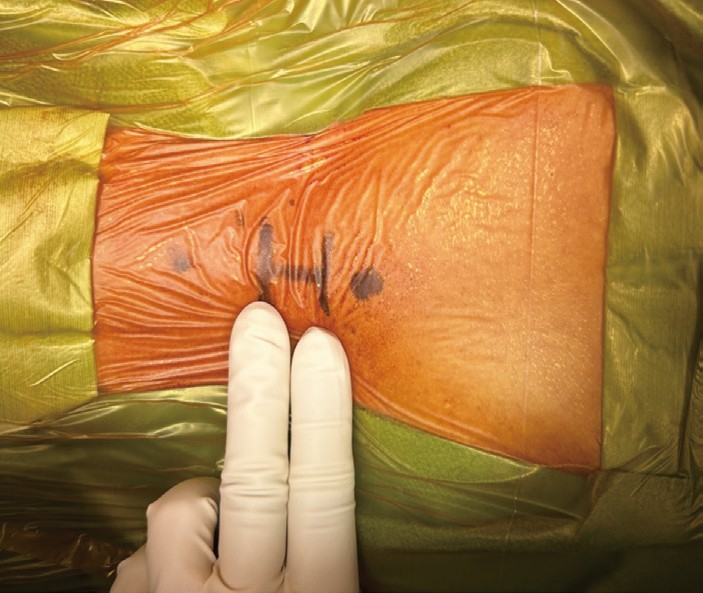 消毒済の皮膚に記した3cm切開ライン — ドレープ上の術野、2本指がスケール